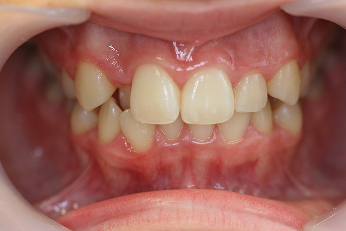 Comprehensive Orthodontics - Before Treatment