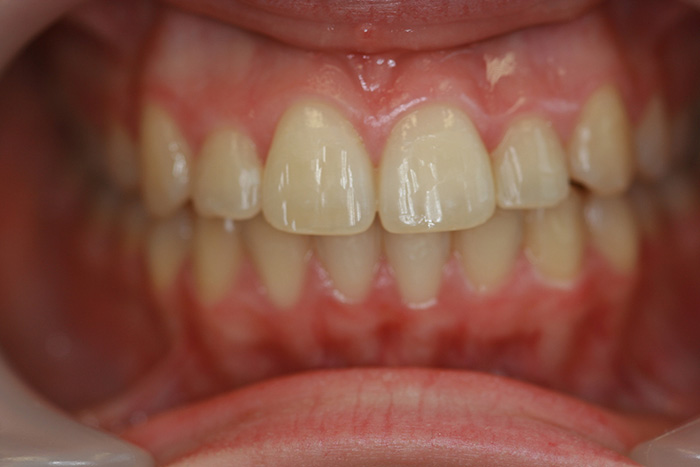 Comprehensive Orthodontics - After Treatment
