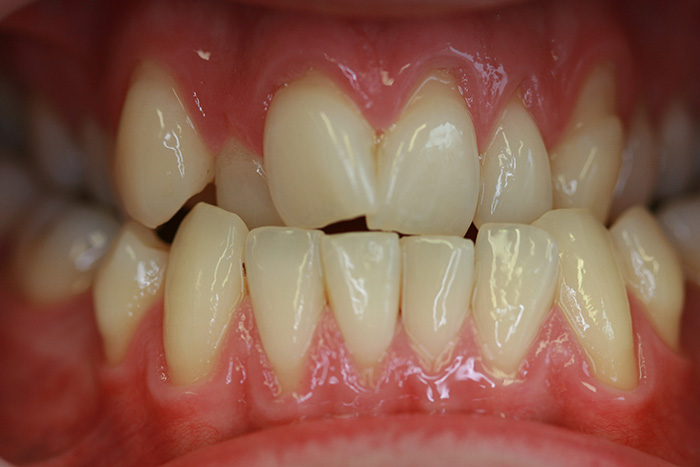 Short Term Orthodontics - Before Treatment