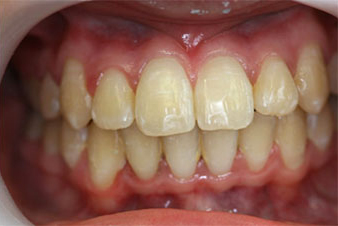 Veneers - After Treatment