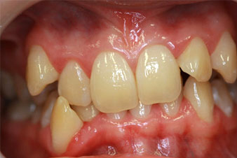 Veneers - Before Treatment