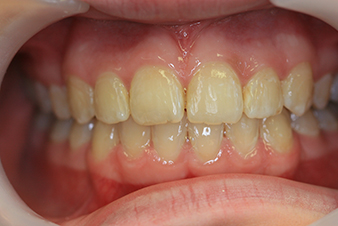 Veneers - After Treatment