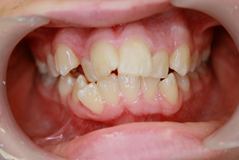 Veneers - Before Treatment