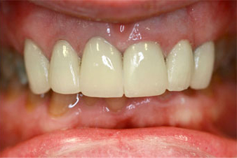 Veneers - After Treatment