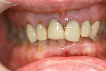 Veneers - Before Treatment