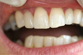 Veneers - After Treatment