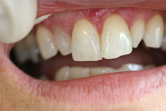 Veneers - Before Treatment